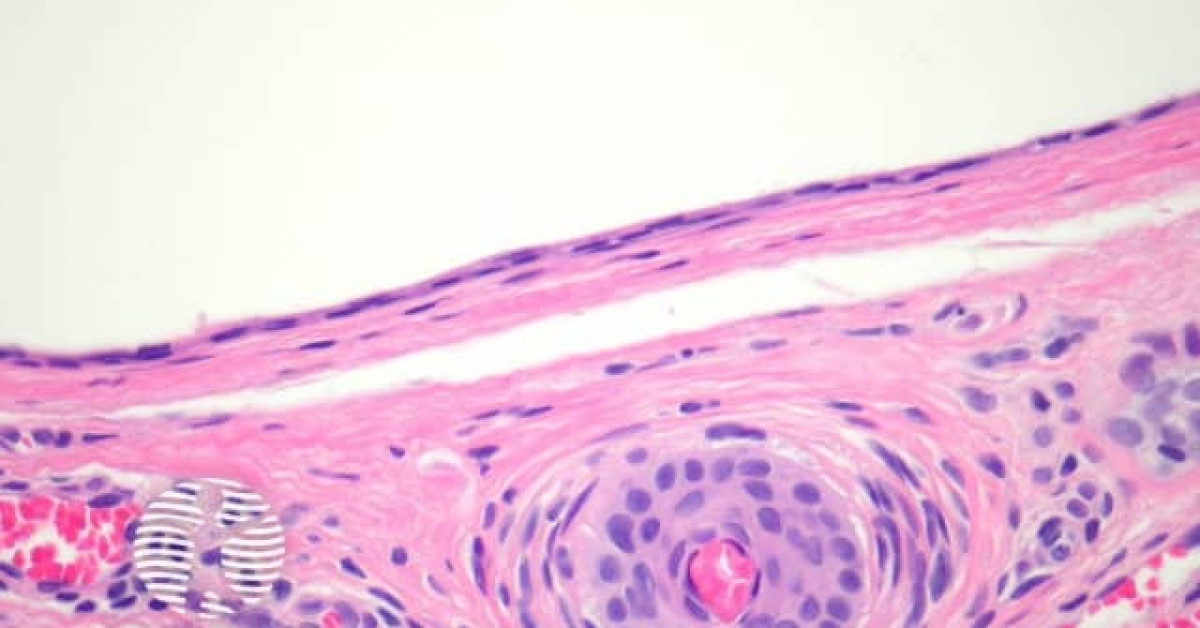 Eccrine hidrocystoma pathology image