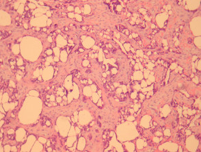 Eccrine papillary adenoma pathology