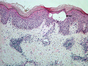 Acute eczema pathology