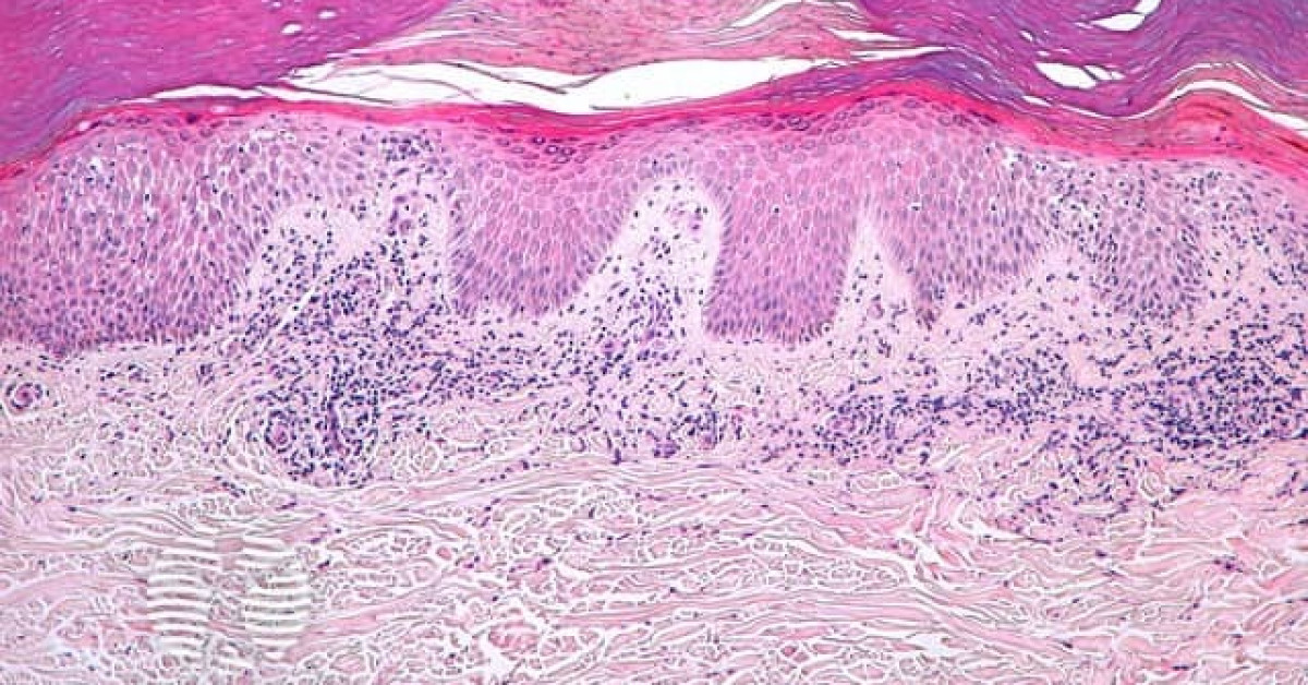 DermNet® - Subacute eczema pathology image