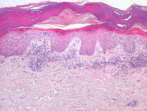 Subacute eczema pathology