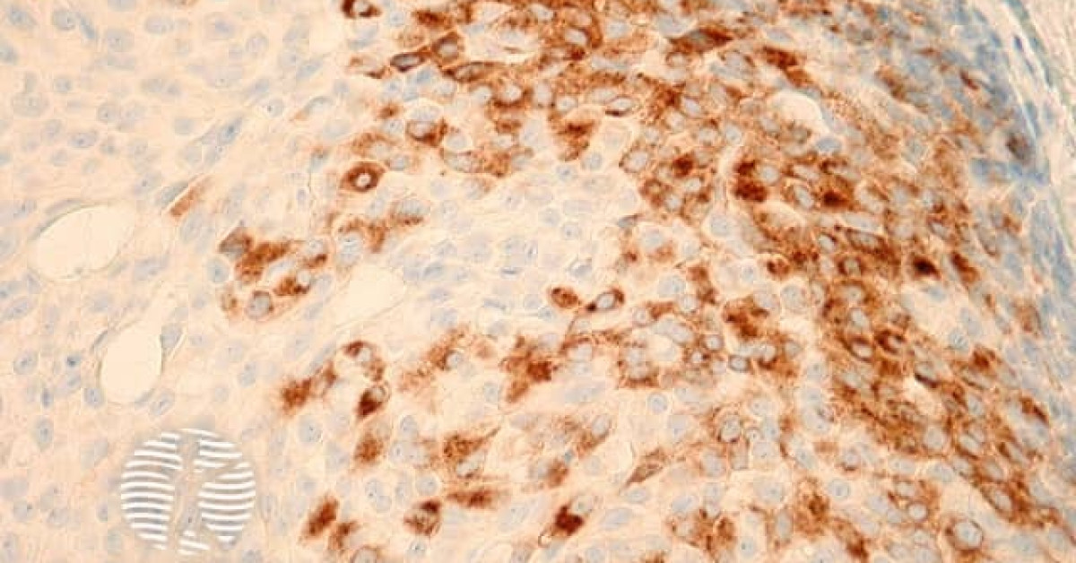 DermNet® - Endocrine Mucin–producing Sweat Gland Carcinoma Pathology Image