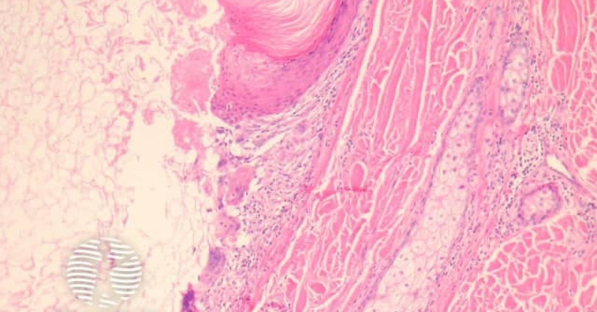 Epidermoid Cyst Pathology Image 6214