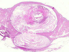 Epidermoid cyst pathology