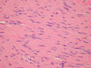Palmoplantar fibromatosis pathology