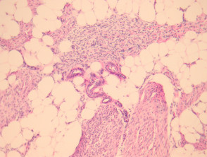 Fibrous hamartoma of infancy pathology