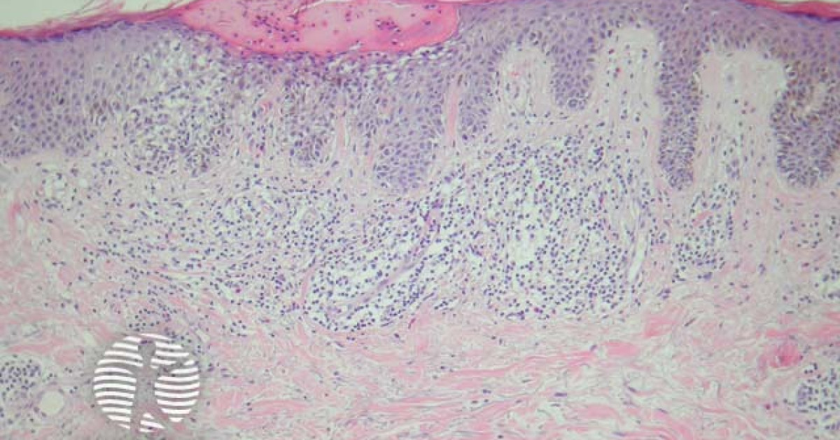 Melanocytic naevus pathology: Meyerson naevus image