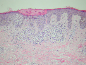 Melanocytic naevus pathology: Meyerson naevus