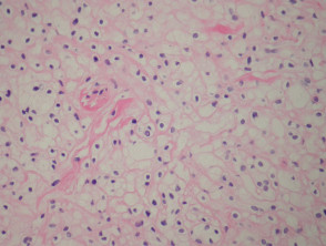 Melanocytic naevus pathology: balloon cell naevus