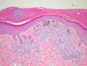 Melanocytic naevus pathology: acral naevus