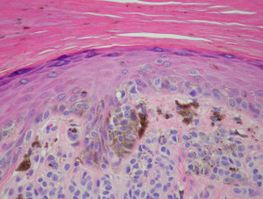 Melanocytic naevus pathology: acral naevus