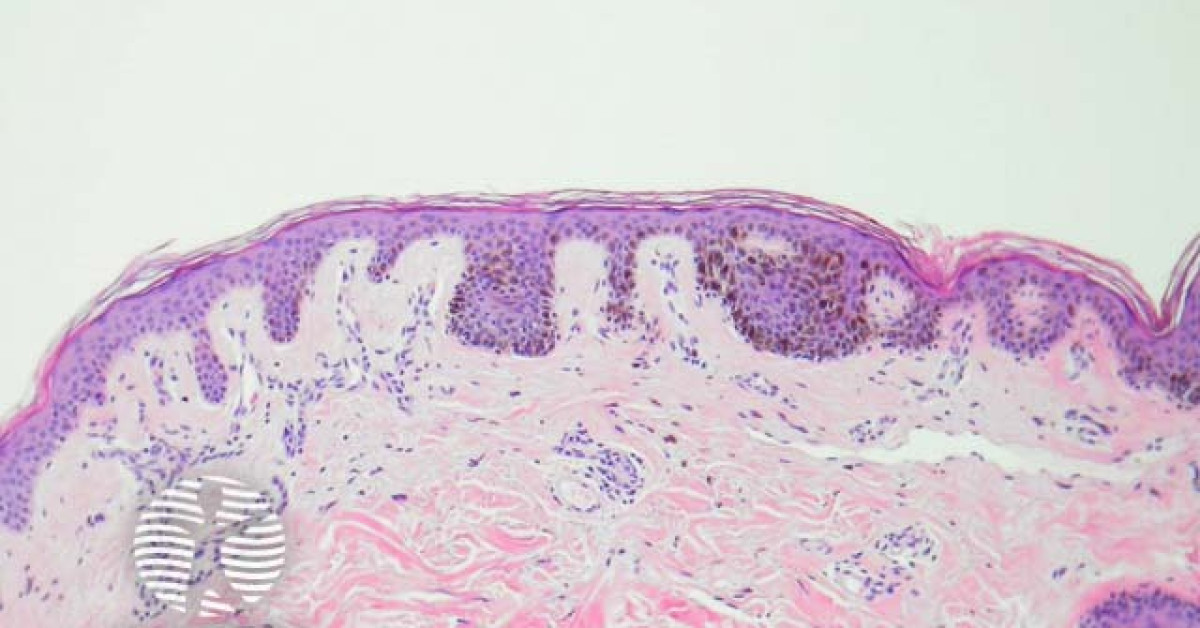 Lentigo simplex pathology image