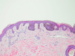 Lentigo simplex pathology