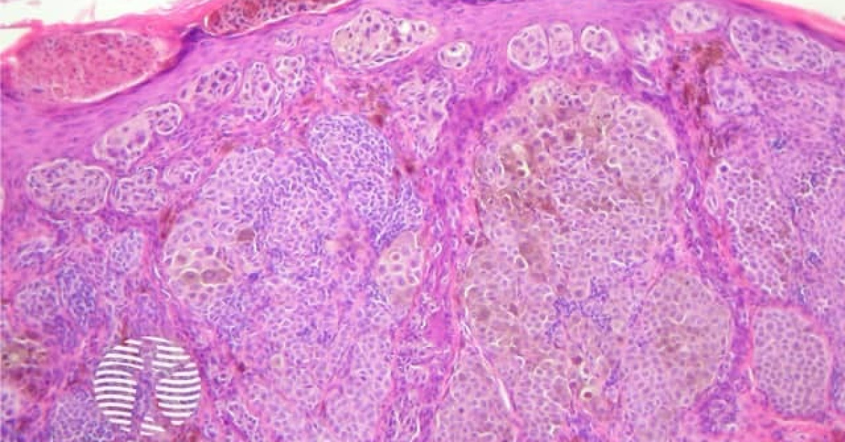 Congenital naevus pathology image