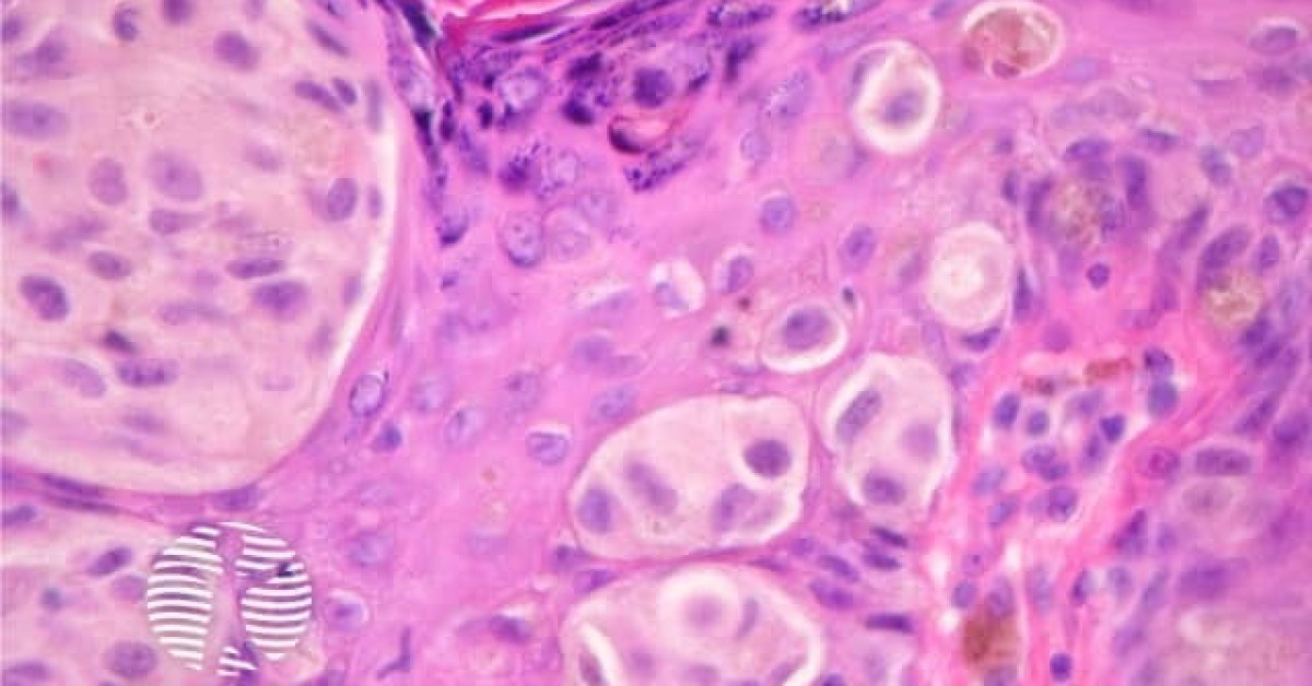 Congenital naevus pathology image