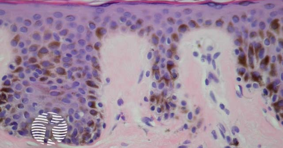 Lentigo simplex pathology image