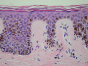 Lentigo simplex pathology