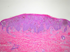 Pigmented spindle cell naevus of Reed pathology