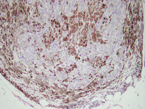 Cellular blue naevus pathology
