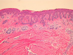 Melanocytic naevus pathology: dysplastic naevus