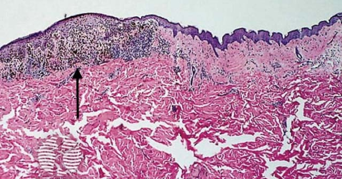 DermNet® - Melanoma pathology: tumour infiltrating lymphocytes image