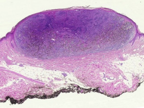 nodular melanoma histology