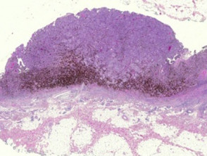 Melanoma pathology: lentigo maligna melanoma