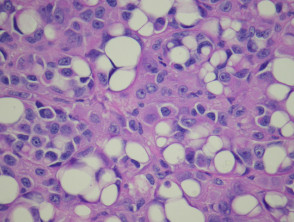 Melanoma pathology: Signet ring melanoma