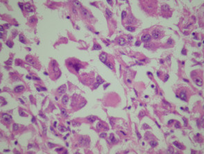 Melanoma pathology: Rhabdoid melanoma