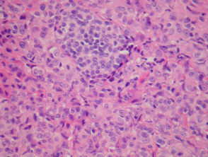 Melanoma pathology: BAP-1 mutation associated melanoma