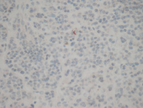 Melanoma pathology: negative BAP-1 staining