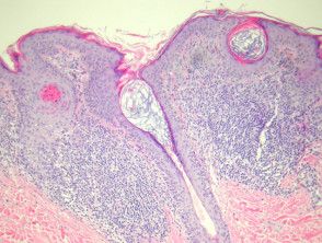 Melanocytic naevus pathology: halo naevus