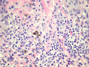 Melanocytic naevus pathology: halo naevus