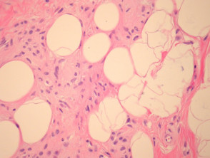 Melanocytic naevus pathology: naevus with fat and neural metaplasia