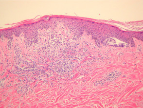 Melanocytic naevus pathology: Superficial Atypical Melanocytic Proliferation of Unknown Significance (SAMPUS)