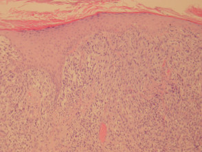 pathology melanoma