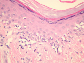 Melanoma pathology: lentiginous melanoma
