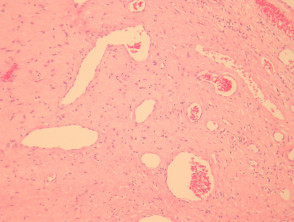 Giant cell fibroblastoma pathology