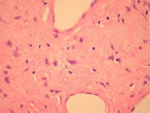 Giant cell fibroblastoma pathology