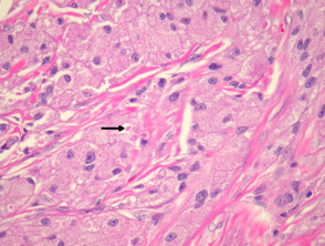 Granular cell tumour pathology