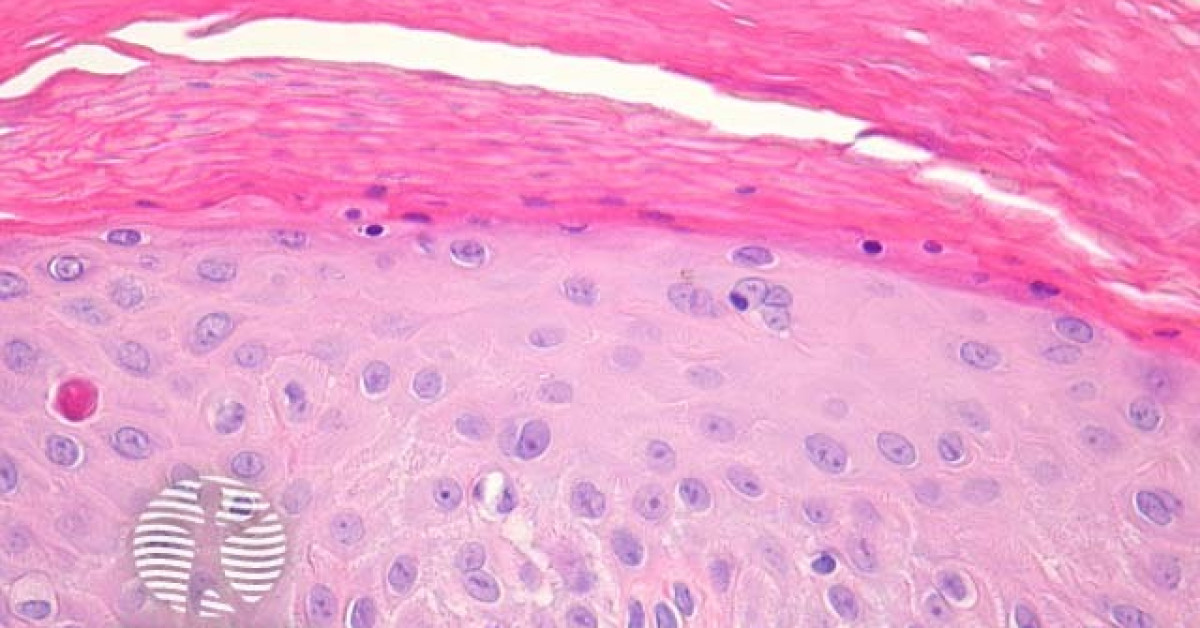 Inflammatory Linear Verrucous Epidermal Naevus pathology image