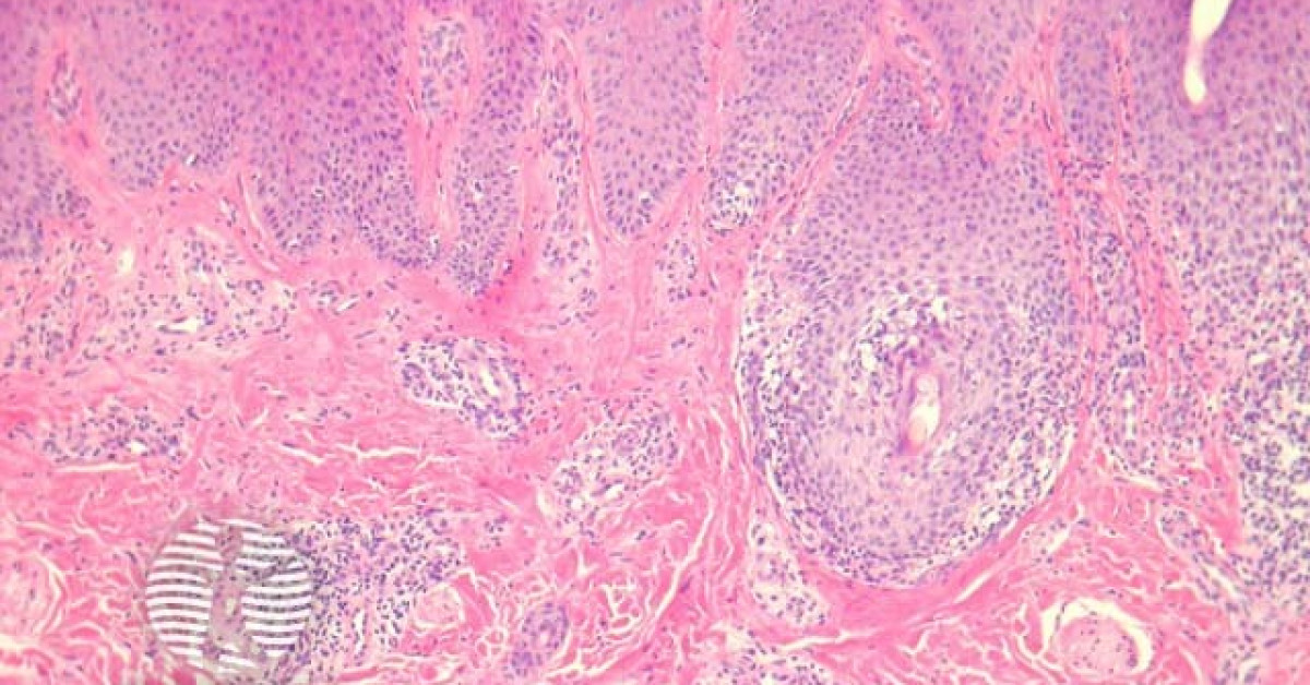 DermNet® - Inflammatory Linear Verrucous Epidermal Naevus pathology image