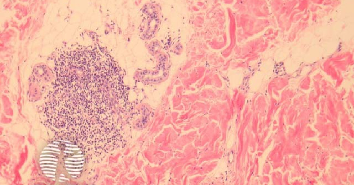 Weird Line Rash Lichen striatus pathology image