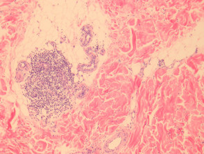 Lichen striatus pathology