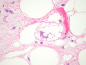 Liposarcoma pathology