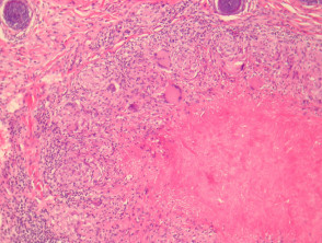 Lupus miliaris disseminatus faciei pathology