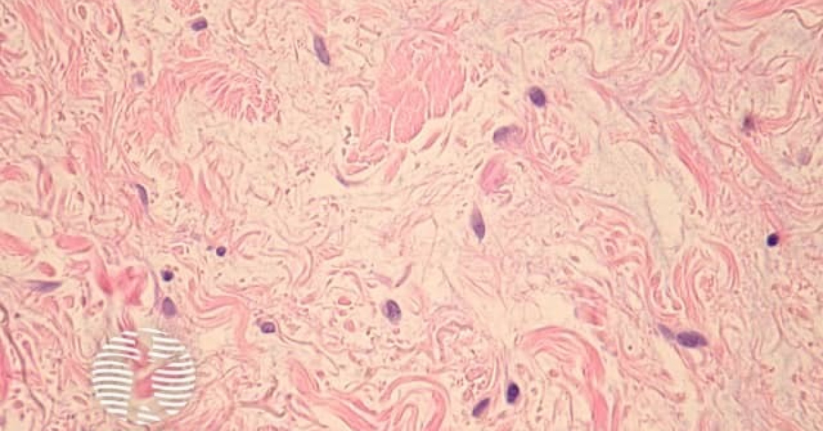 Pathology of discoid lupus erythematosus image