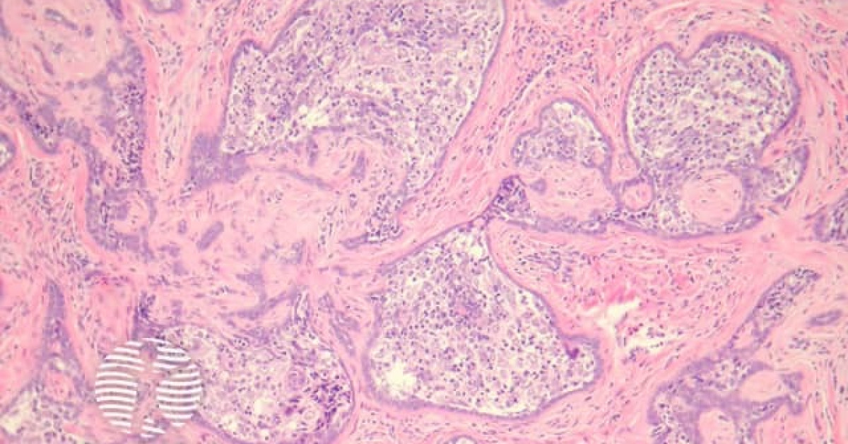 DermNet® - Pathology of cutaneous lymphadenoma image