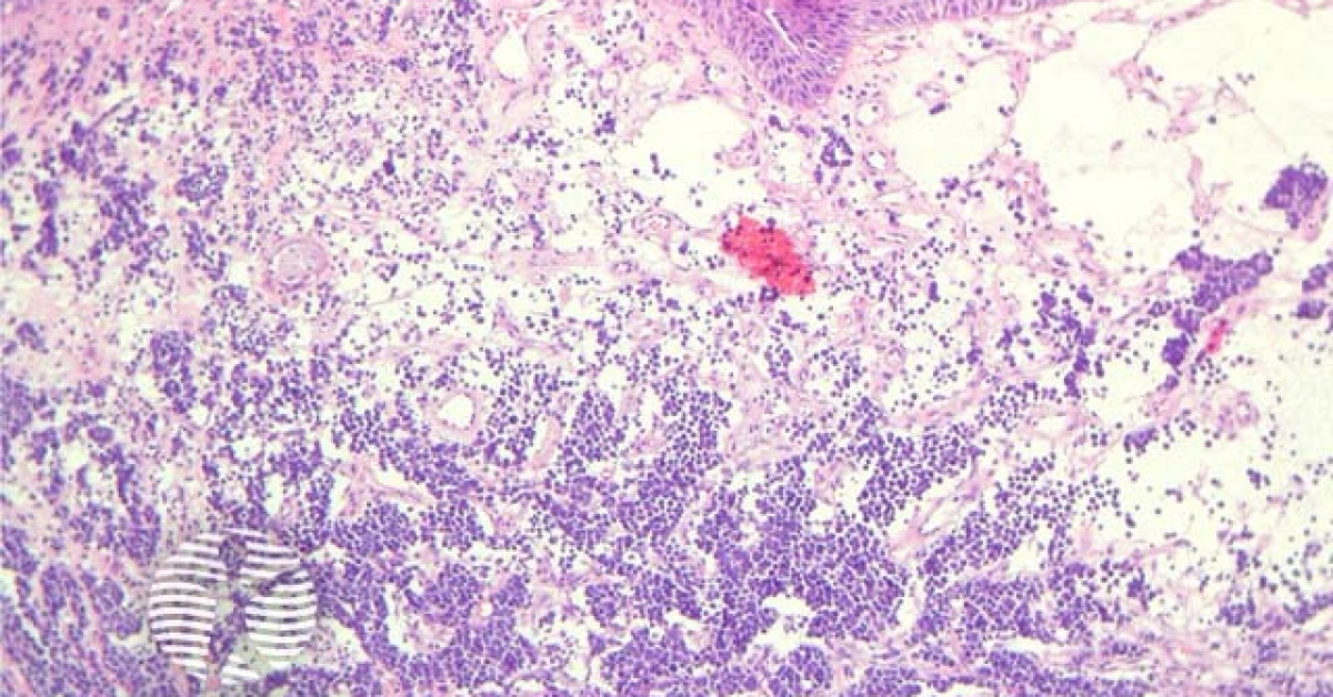 DermNet® - Merkel cell carcinoma pathology image