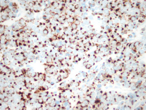 CD20+ in Merkel cell carcinoma pathology